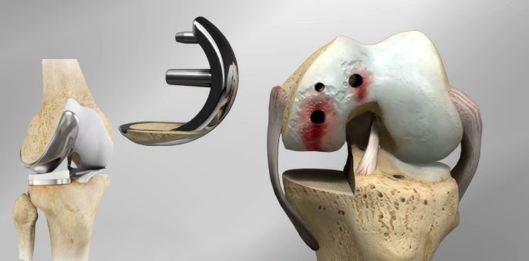 Best Microplasty (Partial Knee Replacement) surgery Surgeon/Doctor/Hospital/Clinic in Ahmedabad, Gujarat, Microplasty (Partial Knee Replacement) doctor Ahmedabad, Microplasty (Partial Knee Replacement) surgeon Ahmedabad