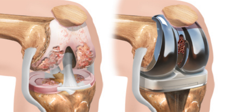 Best tkr surgery Surgeon/Doctor/Hospital/Clinic in Ahmedabad, Gujarat, Total Knee Replacement Surgeon Ahmedabad